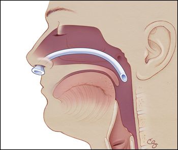 Teleflex Medical назофарингінальна трубка Nasopharyngeal Airway