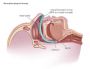 Teleflex Medical назофарингінальна трубка Nasopharyngeal Airway